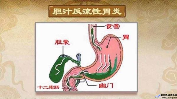 胆汁反流性胃炎会遗传吗(中科本安)