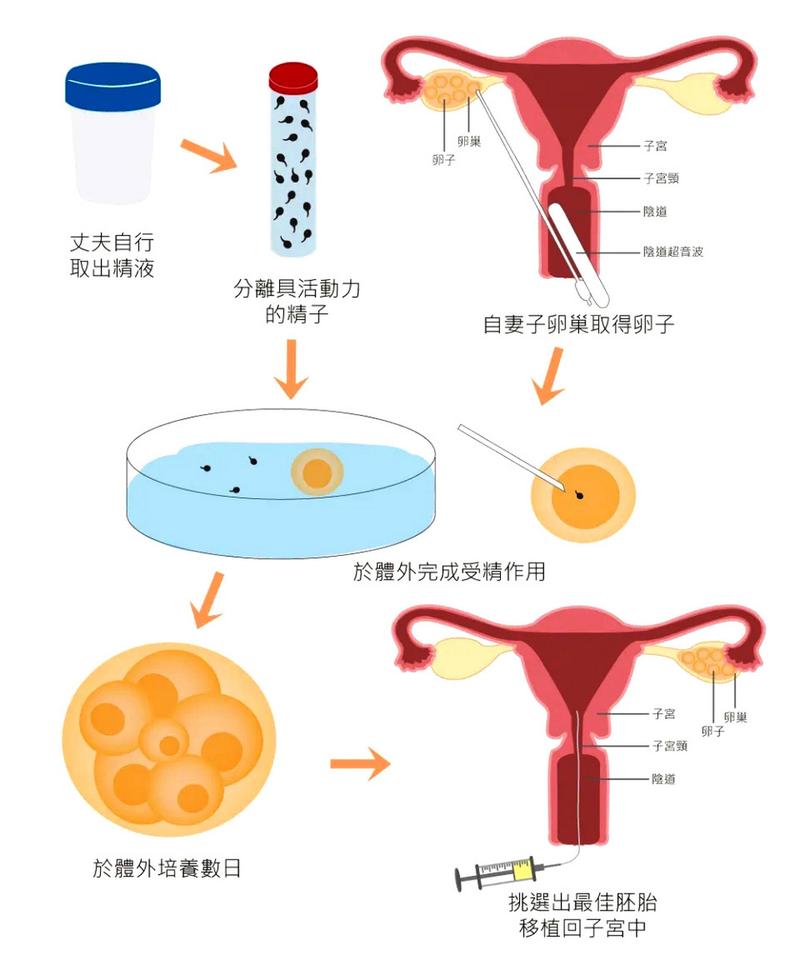 试管婴儿技术选择