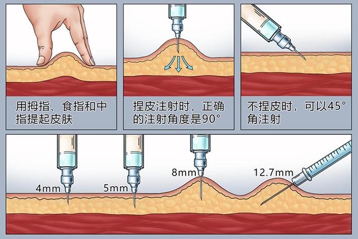 针进入位置