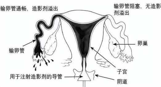 输卵管问题