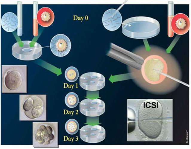  IVF-ET