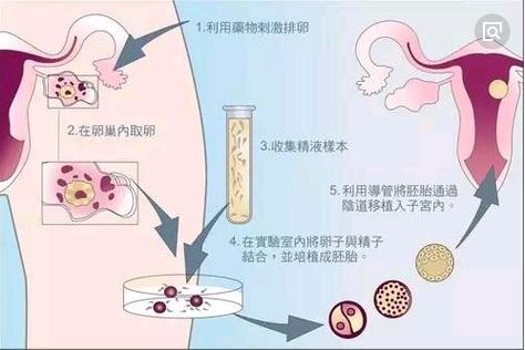  体外受精-胚胎移植技术