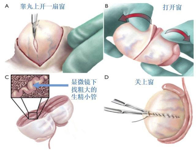 取精环节