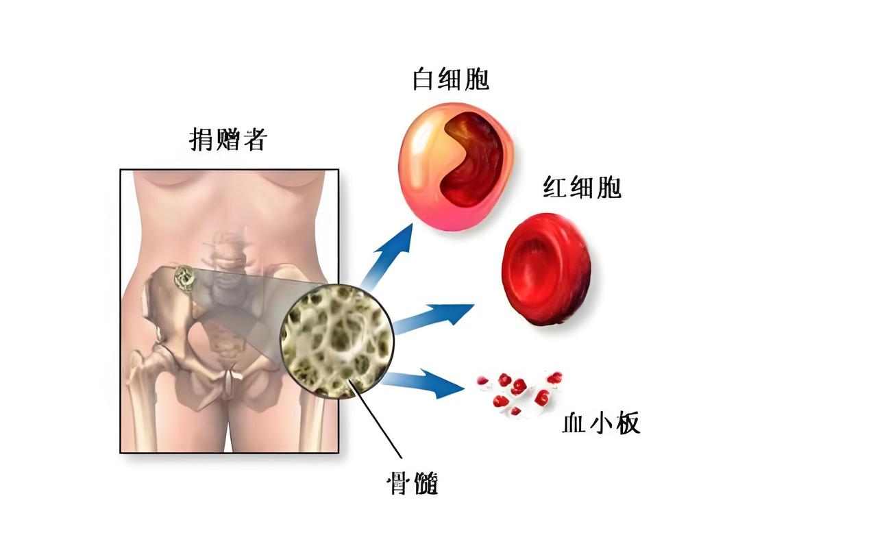  骨髓移植