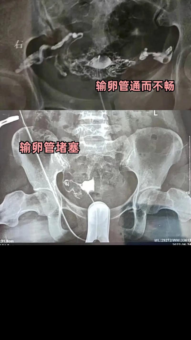 输卵管不通