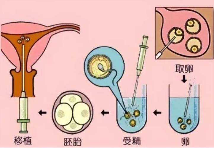 国内供卵试管婴儿