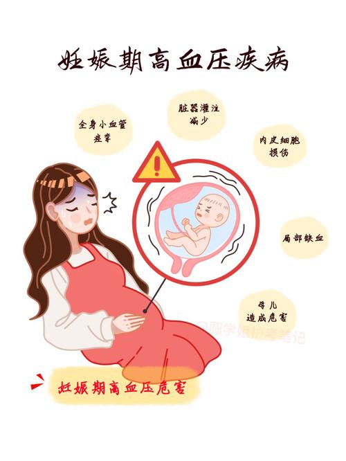  妊娠高血压综合征