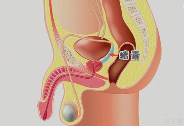 精囊缺失