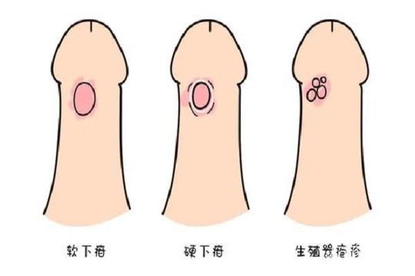 男梅毒患者能否进行试管婴儿治疗？