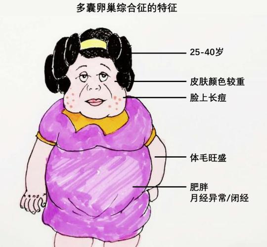 多囊卵巢综合征