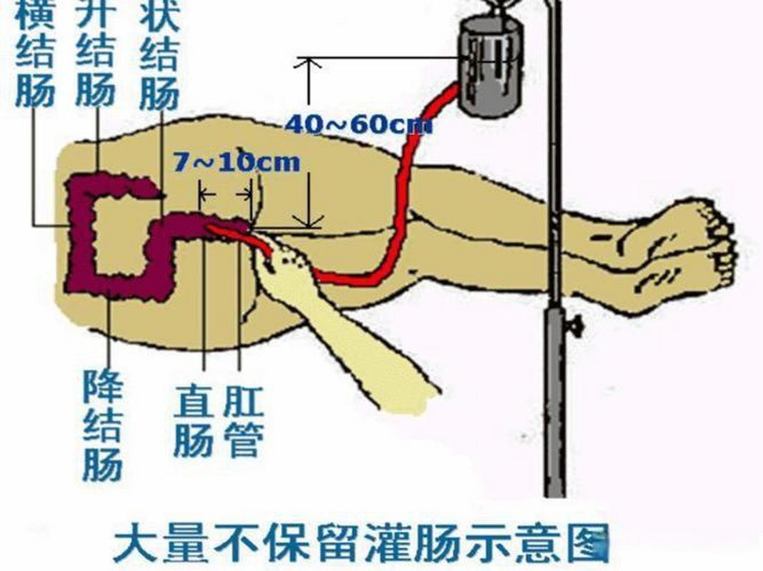 灌肠作用