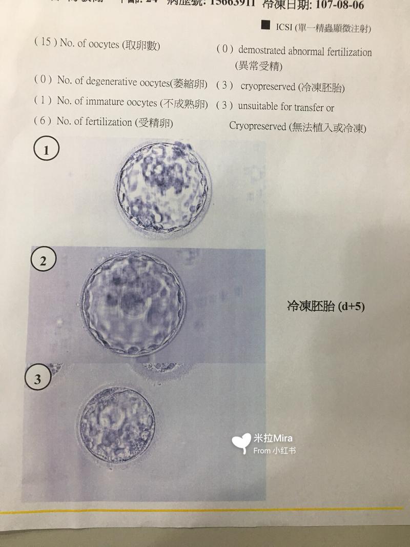 试管婴儿疗程