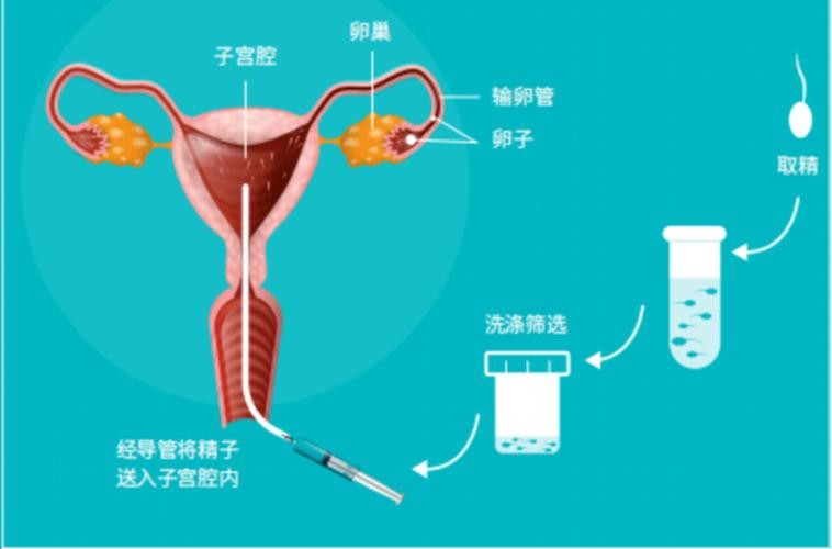 单身女性生育、人工试管婴儿、辅助生殖技术