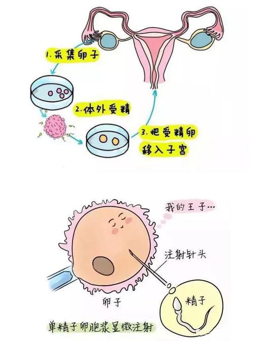 揭秘试管婴儿：和阴道有没有关系？