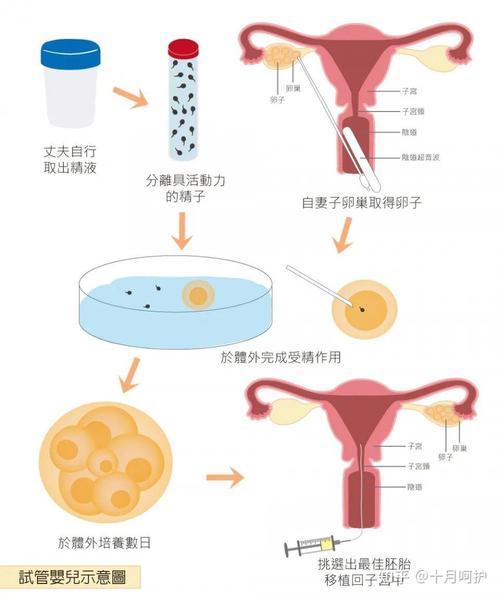 试管婴儿手术是否需要妻子同意？