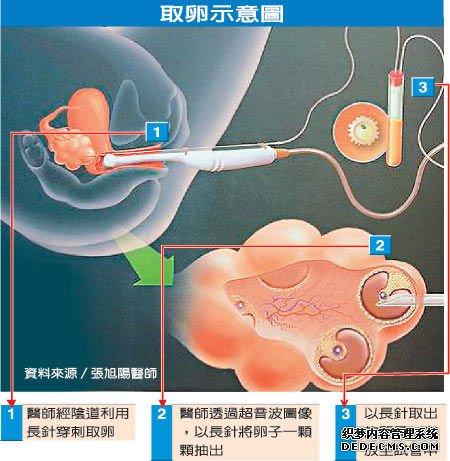 母子试管婴儿取卵的具体过程是什么？