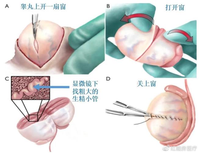 男人如何在试管婴儿过程中顺利取精？