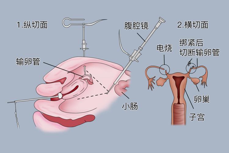 输卵管结扎