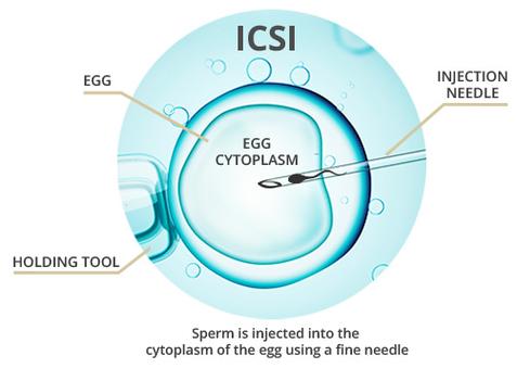  ICSI技术