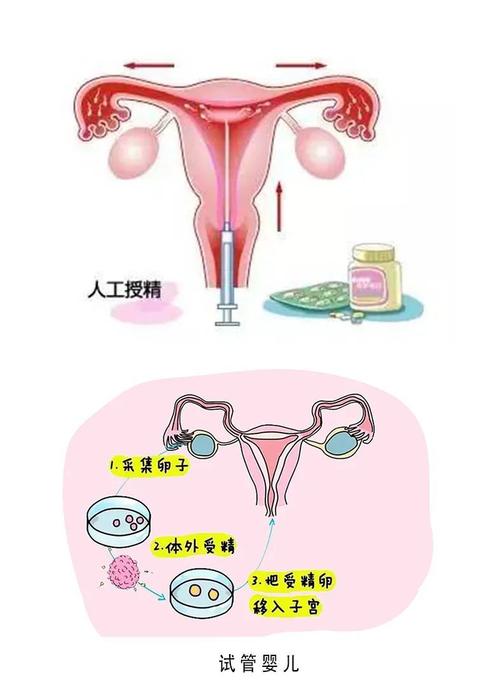 从人工授精到试管婴儿的生育之旅