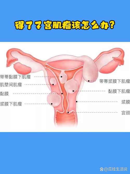 子宫肌瘤手术后如何成功备孕试管婴儿？