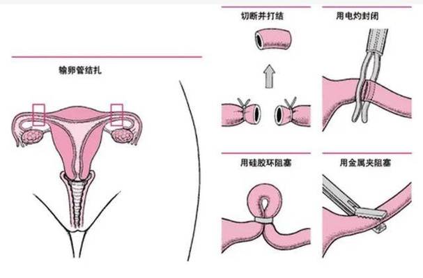 结扎后生育