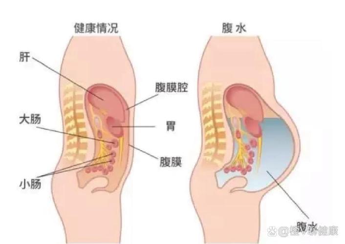 腹水应对