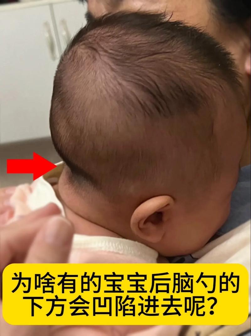  脑后窝发育异常