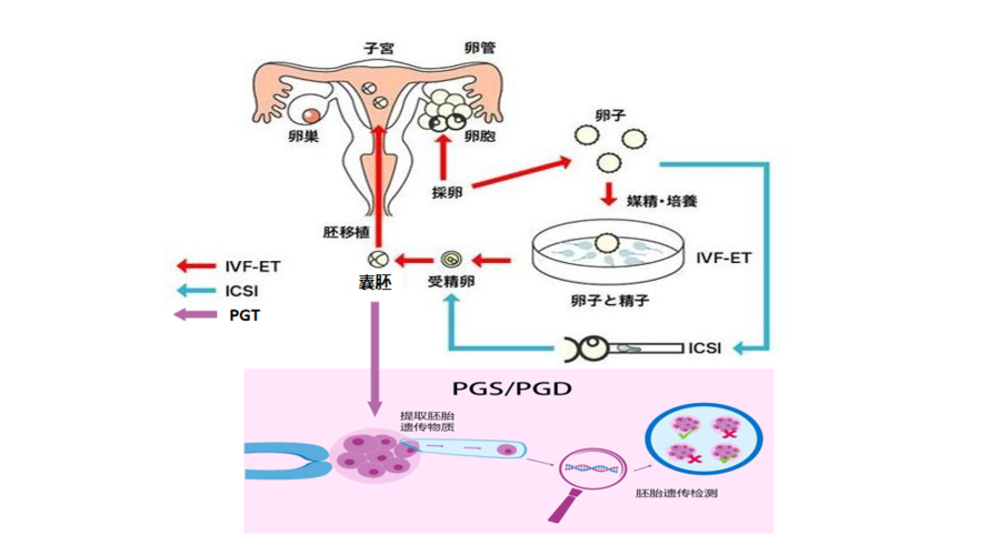 试管婴儿、医疗技术、生殖医学