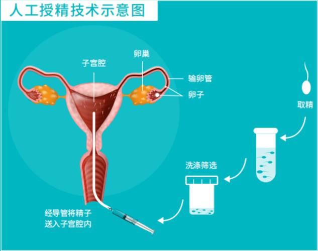 人工受精